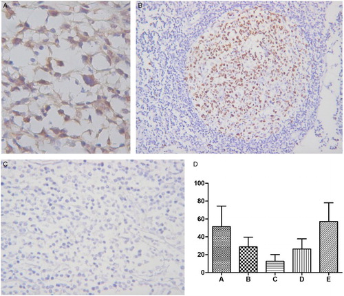 Figure 1 Mad2 expression in PGI-DLBCL. (A) Immunohistochemical staining of Mad2. PGI-DLBCL (stomach) (400×). Mad2 was stained in the cytoplasm and nucleus of tumor cells. (B) Positive control for Mad2 expression. Normal tonsil (200×). Mad2 was mainly expressed in the germinal center. (C) Negative control for Mad2 staining. PGI-DLBCL (stomach) (400×). (D) Statistic analysis of Mad2 expression in PGI-DLBCL. A PGI-DLBCL. B Reactive lymph node (germinal center). C Reactive lymph node (non-germinal center). D Normal gastrointestinal tissue (lymphoid nodule). E Nodal lymphoma of DLBCL. (※) B–D P < 0.01, (#) E P > 0.05.