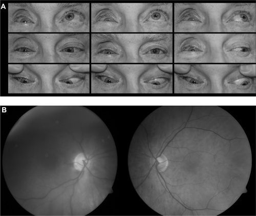 Figure 5 Ocular motility and fundus photographs for Case 2. (A) Nine positions of gaze. The right eye does not move in any direction. (B) Fundus photographs.