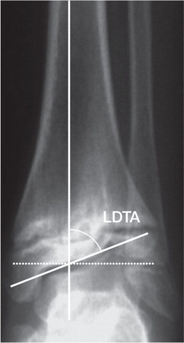 Figure 2. Lateral distal tibial angle (LDTA). This is determined by measuring the angle created by the intersection of the central axis of the tibia and a second line drawn across the epiphyseal surface of the distal tibia.
