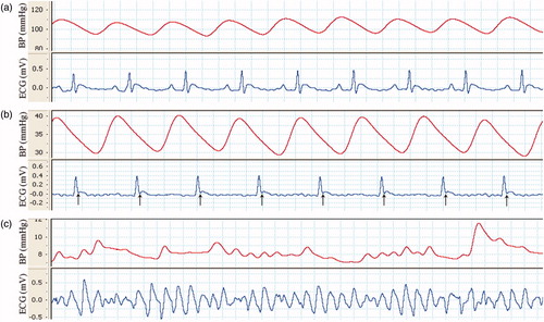Figure 1. The strips of arterial blood pressure and lead II of ECG that simultaneously were recorded from a rat of the CTL group during different periods of experiments. Normal blood pressure and normal sinus rhythm during the pre-ischemic stage (Basal, a), drop of blood pressure and normal sinus rhythm with ST elevation (↑) at the onset of ischemic stage (b) and severe drop of blood pressure and VT/VF rhythm at the beginning of the reperfusion stage (c).