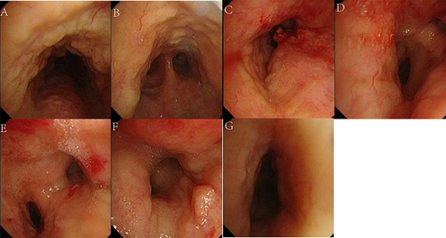 Figure 4 Tracheobronchial images showing the bronchoscopy findings. The mucosa of the trachea and bilateral main bronchi is diffusely and circumferentially thickened, with multiple nodular protuberances and relatively narrow lumens. (A) Trachea. (B) Tracheal carina. (C) Proximal left main bronchus. (D) Distal left main bronchus. (E) Right main bronchus. (F) Right upper lobe bronchus. (G) Middle segment bronchus of right lung.