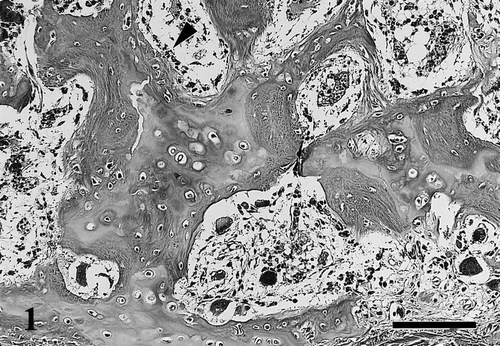 Fig. 1 Decalcified section of the sternum. Trabecular bone mainly composed of thick unmineralized osteoid seams occasionally lined by osteoblasts (arrowhead). Haematoxylin and eosin (HE). Bar=100 μm.