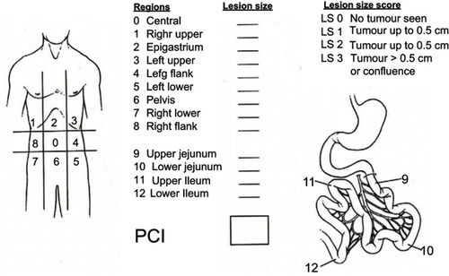 Figure 3  Regions for calculating the peritoneal carcinomatosis index (PCI).