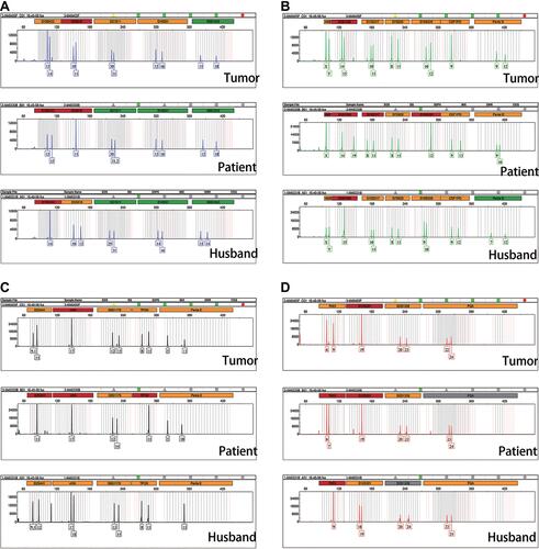 Figure 3 DNA polymorphic analysis. (A–D) Genetic profiles of 21 highly polymorphic short tandem repeats (STRs) from tumor, the patient and spouse were compared. At 7/21 valid loci (D19S433, D7S820, D8S1179, TPOX, Penta E, D12S391, FGA) examined, tumor sample was found to contained both the maternal and paternal allele, demonstrating its gestational origin. Y-axis: fluorescence intensity of the labeled product. X-axis: allelic sizes in base pairs, such that the number stands for repeat size in each short tandem repeat locus and can be highly variable among individuals.