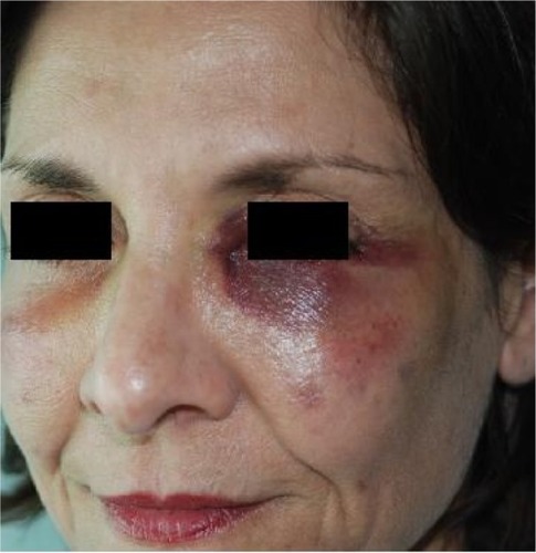 Figure 1 Bruising may be immediate or worsen over 3 days.