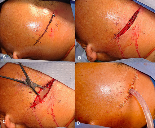 Figure 2 Surgical procedures of a patient treated with the MIVD device. (A) A submandibular incision was design. (B) The platysma muscle and the superficial layer of the deep fascia were incised successively. (C) A blunt separation was made into the abscess cavity to thoroughly remove purulence. (D) The incision was sutured closely after the MIVD device being put into the patient’s body.