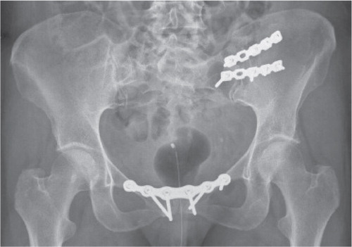 Figure 14. Radiograph of a unilateral anterior fusion combined with fusion to the pubic symphysis.