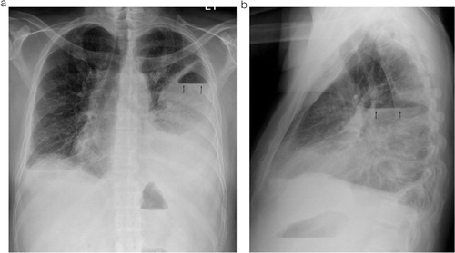 Fig. 1 (a) PA and (b) lateral views of the chest demonstrate a large left pleural collection with an air-fluid level (arrows). Small right pleural effusion is also seen.