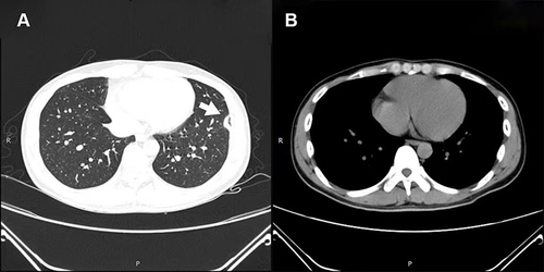Figure 4 Chest CT after 1 month of treatment. (A) Arrow shows that pneumonia was resolved, and (B) arrow shows that pleural effusion disappeared.