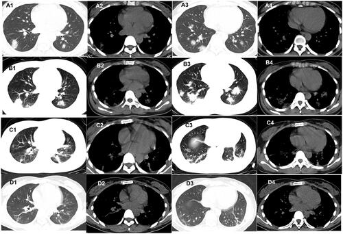 Figure 3. Evolution of the nodules on chest CT of patients with COVID-19. A 27-year-old woman who had close contact with individuals in Wuhan presented with fever and fatigue for 3 days. (A1–A4) The first non-contrast-enhanced chest CT reveals multiple nodules in the left and right lower lobes (initial chest CT). (B1–B4) Follow-up chest CT 4 days after the first shows that both the scope and density of the lesions increase (stage I*); (C1–C4) Follow-up chest CT 8 days after the first shows that both the scope and density of the lesions decrease (stage II*). (D1–D4) Follow-up chest CT 12 days after the first shows that the lesions are almost absorbed completely (stage III*). *The stage does not represent the course of COVID-19 but the time interval between the two adjacent CT scans.