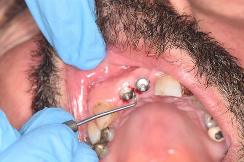 Figure 2 Probing around the healing abutment to measure IMI and PI using a CPITN periodontal probe.