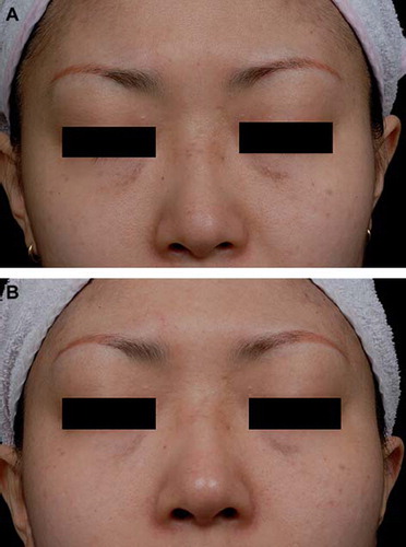 Figure 2. The ABNOM lesions in the second patient are on the lower eyelids as well as on the root of the nose and temples before (A) and 2 months after (B) two successive 1064-nm QS Nd:YAG treatments.