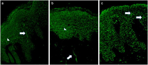 Figure 1. Micrographs showing an intraepidermal CGRP positive nerve-like fiber (arrow) and CGRP-positive keratinocyte (arrowhead) (a), sprouting of CGRP positive nerve-like fibers and CGRP-positive keratinocyte (arrowhead) (b), CGRP-positive intraepidermal dendritic cells (c). magnitude x 400.
