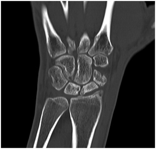 Figure 1. Preoperative computed tomography scan image showed scaphoid nonunion with wide necrosis areas with no evidence of radiocarpal arthritis or scaphoid nonunion advanced collapse wrist.