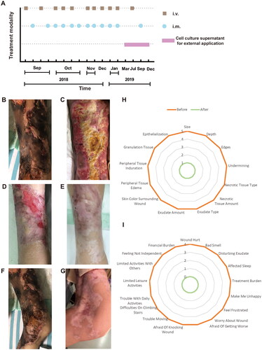 Figure 1. Flow chart of hAMSC treatment and skin regeneration, quality of life in the CUA patient. (A) Flow chart of hAMSC treatment. (B-E) Healing process of the skin lesions on the right thigh during the course of hAMSC treatment. (B) The anterior of right thigh presenting with large areas of irregular black scab, superficial ulceration and slight exudation before hAMSC treatment. (C) Patchy shallow ulcer covered with granulation tissues, pale yellow necrotic tissues and crusting in the center after hAMSC treatment for 2 months and debridement. (D) Striated scar with reddish dry ulcer in the center, pigment reduction in the peripheral, dilated blood vessels and a small amount of local crusting after hAMSC treatment for 9 months. (E) Fully regenerated skin accompanied with irregularly shaped scar, localized hypopigmentation and few scabs in the right thigh after hAMSC treatment for 20 months. (F) The left knee presenting with large black eschar and scattered deep ulcers before treatment. (G) Scar healing on the left knee with hypopigmentation after hAMSCs for 15 months. (H-I) Wound assessment based on BWAT(H) and quality of life evaluated by Wound-QoL(I) after hAMSC treatment for 15 months. hAMSC: human amnion-derived mesenchymal stem cell; CUA: calcific uremic arteriolopathy; BWAT: Bates-Jensen Wound Assessment Tool; Wound-QoL: Wound-Quality of Life.