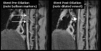 Figure 1. MRI-guided stenting.