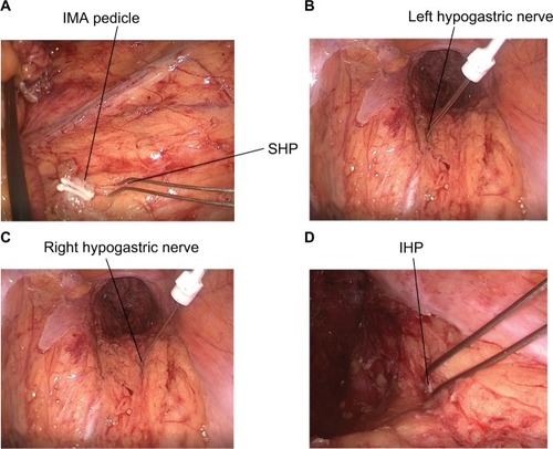 Figure 2 Pelvic autonomic nerves stimulated by a bipolar probe during surgery.Note: (A) Intraoperative monitoring of SHP; (B) intraoperative monitoring of left hypogastric nerve; (C) intraoperative monitoring of right hypogastric nerve; and (D) intraoperative monitoring of right IHP.Abbreviations: IHP, inferior hypogastric plexus; IMA, inferior mesenteric artery; SHP, superior hypogastric plexus.