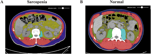 Figure 2 Computed tomographic scans showing areas of skeletal muscle (red, green, and blue), visceral adipose tissue (yellow), and subcutaneous adipose tissue (purple) in patients with sarcopenia (A) and without sarcopenia (B).