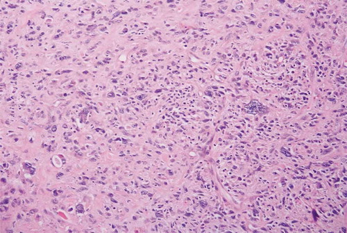 Figure 3. Histopathology of atrial mass revealing it to be a rhabdomyosarcoma.