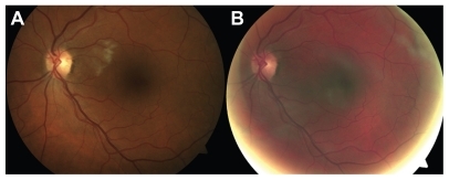 Figure 1 Left fundus photographs: at presentation showing an isolated cotton-wool spot (A); and 9 weeks later showing resolution (B).