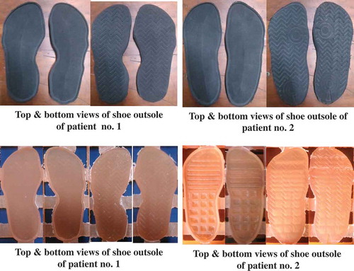 Figure 9. Outsole of shoes manufactured for two patients.