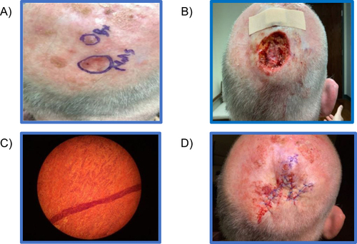 Figure 4 Various stages of treatment for Case 3. (A) Presentation; (B) Mohs surgery; (C) Histological diagnosis; (D) Post-procedure.
