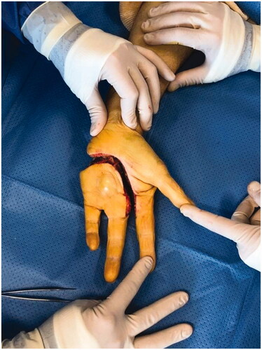 Figure 3. Palmar view of the hand after transcarpal amputation.