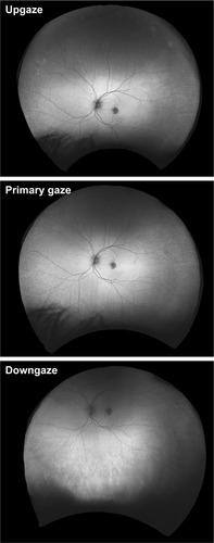 Figure 1 Gaze positions to optimally capture entire fundus in ultra-widefield imaging. Images were routinely captured in primary gaze, upgaze and downgaze. While primary gaze images reflect the temporal and nasal periphery reasonably well, it is necessary to capture images in upgaze and downgaze to better show the superior and inferior periphery as demonstrated in this ultra-widefield autofluorescence image sequence of a left eye.