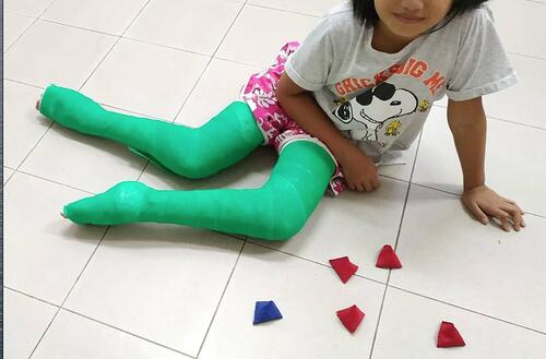 Figure 3 Sitting on the floor in long leg casts; she was able to move across the room despite the casts.