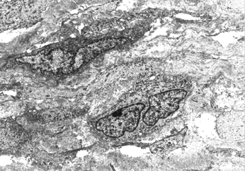 Fig. 4 Conventional electron microscopy from a spindle-celled area of the tumor, × 5,400.