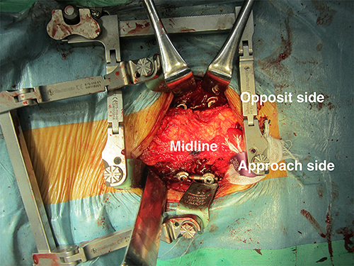 Figure 3 Pedicle screws were inserted through the open method for the approach side and the subcutaneous transfascial method for the opposite side under X-ray fluoroscopic control in the TLIF group.