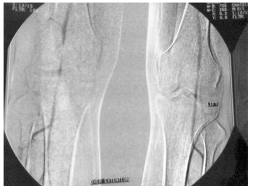 Figure 2 Computed tomographic angiogram findings with bilateral popliteal artery entrapment syndrome.