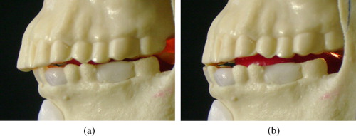 Figure 7. (a) Retruded and (b) frontal closures produced by AnTon.