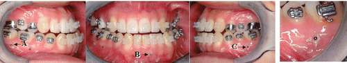 Figure 1. Reference points on the lower dental arch. A, B and C are reference points glued to the attached gingiva with an adhesive agent at the right molar, incisal and left molar regions, respectively. [Color version available online.]