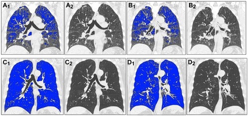 Figure 1 An example of air trapping heterogeneous distribution on full-expiration (A–D). The blue colored areas showed pixels of <-856 HU, suggestive of air trapping. (A,B) which were the different coronal slices of the same patients (not same with C,D) showed a heterogeneous distribution of AT. (A1,A2) were the same coronal slice and (B1,B2) were the same coronal slice. FEV1 (L)= 2.18, FEV1(%pred)= 71%, FVC (L)= 3.67, FEV1/FVC= 59%, IC/TLC= 40%. (C,D) which were the different coronal slices of the same patients showed a homogeneous distribution of AT. (C1,C2) were the same coronal slice and (D1,D2) were the same coronal slice. FEV1 (L)= 0.74, FEV1(%pred)= 30%, FVC (L)= 2.16, FEV1/FVC= 34%, IC/TLC= 20%.