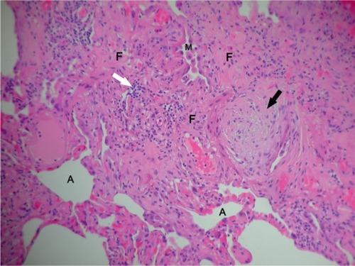 Figure 1 Histology of a video-assisted thoracic surgical lung biopsy showing a fibroblastic focus (black arrow), areas of fibrosis (F), intra-alveolar macrophages (M), chronic inflammatory cells (white arrow), and residual alveolar spaces (A).