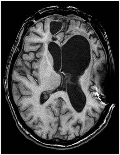 Figure 7. T1 weighted image of extensive damage in severe TBI where the patient either performed without error or only made one error across three SVT measures. The scan is in radiological perspective with left on the viewer’s right. Note that, despite the distinct bifrontal pathology, this patient with severe structural damage had no difficulty passing all SVT measures administered.