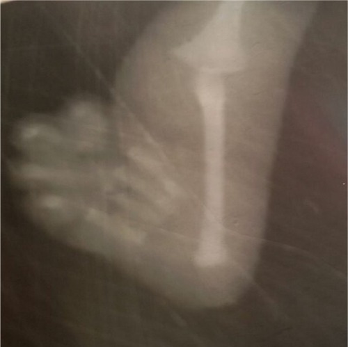 Figure 3 X-ray of upper limb showing absence of radius bone in the patient.