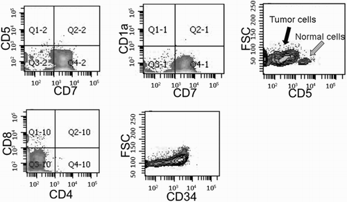 Figure 1. Immunophenotyping of ETP. Tumor samples from a patient (UPN 6) before induction chemotherapy showed ETP phenotype of CD1a−, CD8−, and CD5dim, in conjunction with expression of stem cell antigen CD34.