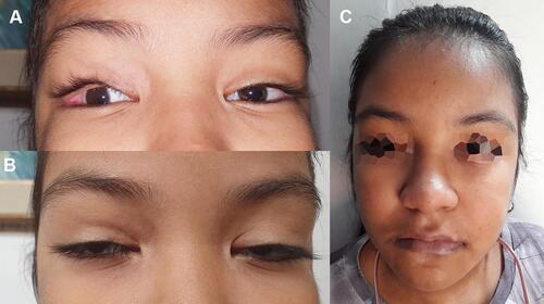 Figure 1 Facial characteristics. (A) Image of the patient where microphthalmia and eversion of the lateral third of the eyelid are observed. (B) Image of the patient with arched eyebrows, long palpebral fissures and wide nasal bridge, facial characteristics of kabuki syndrome. (C) Patient’s whole face image shows the dysmorphic characteristics previously described.