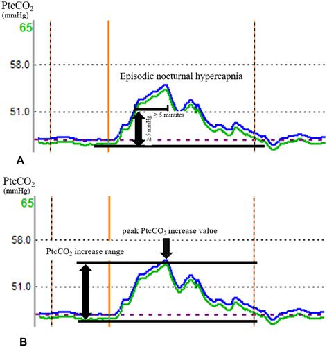 Figure 1 Episodic nocturnal transcutaneous carbon dioxide pressure increase observed during overnight transcutaneous carbon dioxide pressure monitoring.