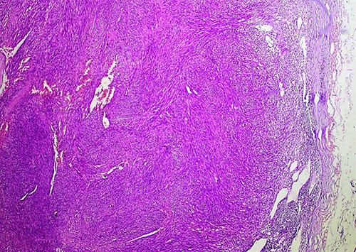 Figure 4 Under10X magnification, shows a hemorrhagic background containing a cohesive cluster of slender spindle cells set in a pinkish stroma.