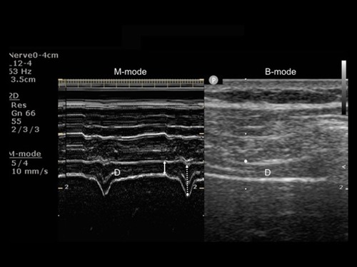 Figure 4 The diaphragm (D) can be identified as the structure comprised between two hyperechoic lines representing the pleural and peritoneal membranes and a middle hypoechoic layer representing the diaphragmatic muscle fibers. In M-mode (left panel), diaphragm thickness is measured at end-expiration (full arrow) and at end of maximal inspiration (dotted arrow) to derive TFdi (see text). B-mode (right panel) is used for anatomical localization of the zone of apposition of the diaphragm.