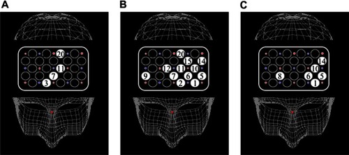 Figure 2 Maps of cortical distribution of channels that were significantly smaller in patients than in healthy subjects during TMT-A, TMT-B, and B–A activation. (A) TMT-A; (B) TMT-B; (C) B–A activation.