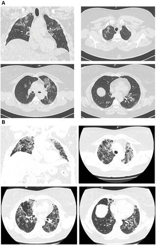 Figure 1 (A) Case 1. Bilateral GGO with poorly defined margins and multiple patchy opacity with slight thickening of pulmonary interstitial structures. (B) Case 1. Larger extension of the opacities, with parenchymal changes including consolidations and signs of reticular interstitial thickening, linear scarring and volume loss at the upper lobes.