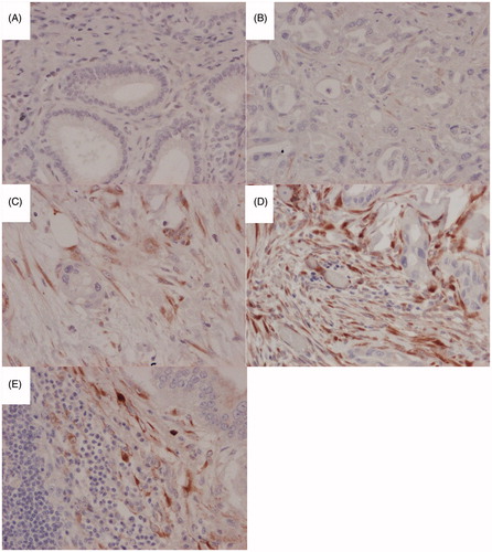 Figure 1. Representative immunohistochemical images at 200 x magnification of SPARC expression in the stromal compartment of distal cholangiocarcinoma (A), negative expression, (B) weak expression, (C) moderate expression, (D) strong expression, (E) Strong stromal SPARC expression in a paired lymph node metastasis.