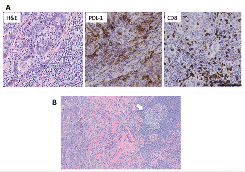 Figure 3. TILs, PDL-1 expression, CD8+ distribution and TLS in the tumor of patient ID#32. (A) Example of tumor with 80% stromal TILs, as assessed on H&E sections. The tumor showed strong expression of PDL-1 on the cancer cells and infiltrating immune cells, and CD8+ T cells infiltrating tumor cell nests. Magnification 200X, bar = 100 μm. (B) TLS (arrow) was present at the periphery of the tumor. Magnification 100X.