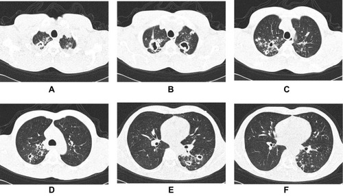 Figure 1 A 44-year-old male patient with PDR-TB. CT scans showing a wide range of lesions were involved, including multiple thick-walled cavities, proliferative lesions, calcifications, and disseminated lesions along the bronchi in both lungs (A–F).