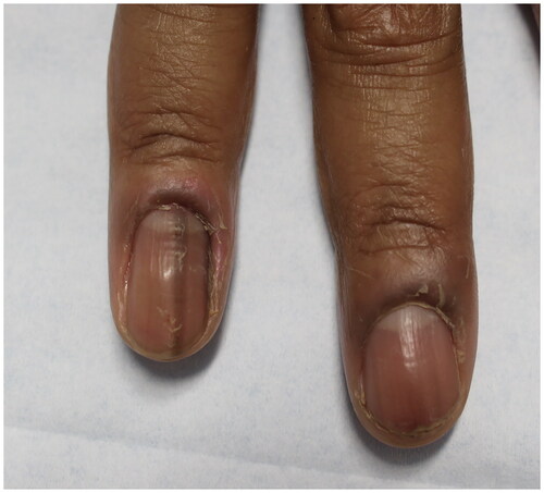 Figure 8. Chronic paronychia presenting with edema of the right third and fourth nail folds. Of note, there is also benign longitudinal melanonychia of the right 4th fingernail.
