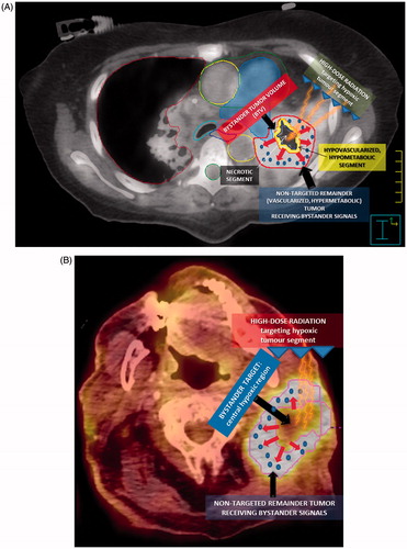 Figure 1. Radiobiology of the bystander effect. (A, B) The figure summarizes the main features of the reported radiation technique for the induction of the bystander effect by partially irradiating only the hypoxic tumor segment. An 18F-FDG PET in combination with a contrast enhanced CT, previously fused with the simulation CT, was used for the definition of the hypoxic tumor segment, a so called ‘bystander target’ (a smaller contour). This area, which includes the junctional region between the necrotic tumor segment (central region) and the contrast-enhanced and PET-positive remainder peripheral tumor (a bigger contour that was not targeted for irradiation), was targeted with high-dose radiation. The arrows represent the bystander signals (pellets) released by the irradiated hypoxic segment, which transmit damage to the remainder of the un-irradiated part of the tumor, causing regression of the whole tumor, both in the targeted and non-targeted region.